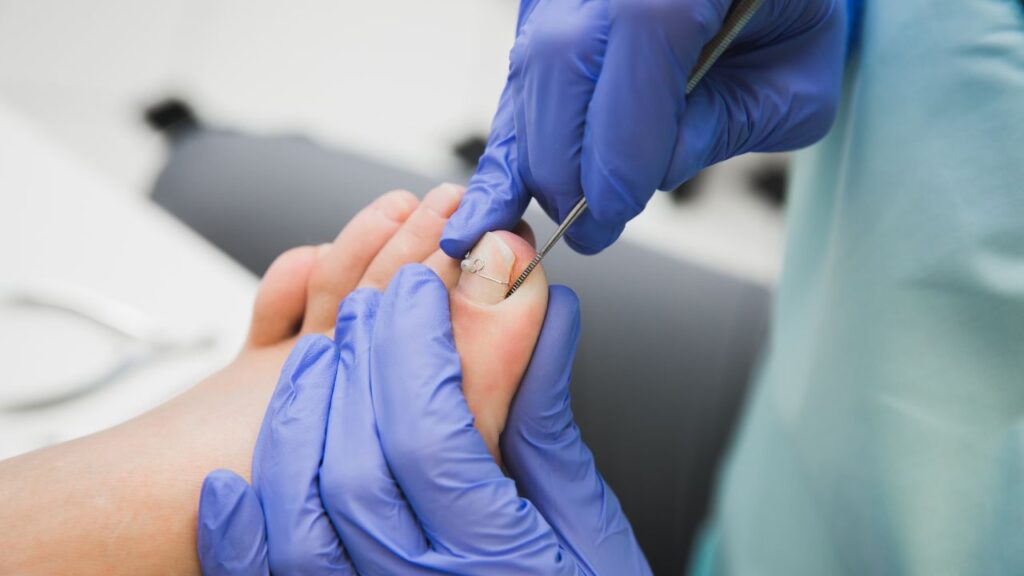 How to Identify and Treat Ingrown Toenails
