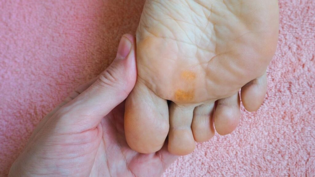 How to Prevent and Treat Calluses and Corns: Podiatric Tips and Treatments