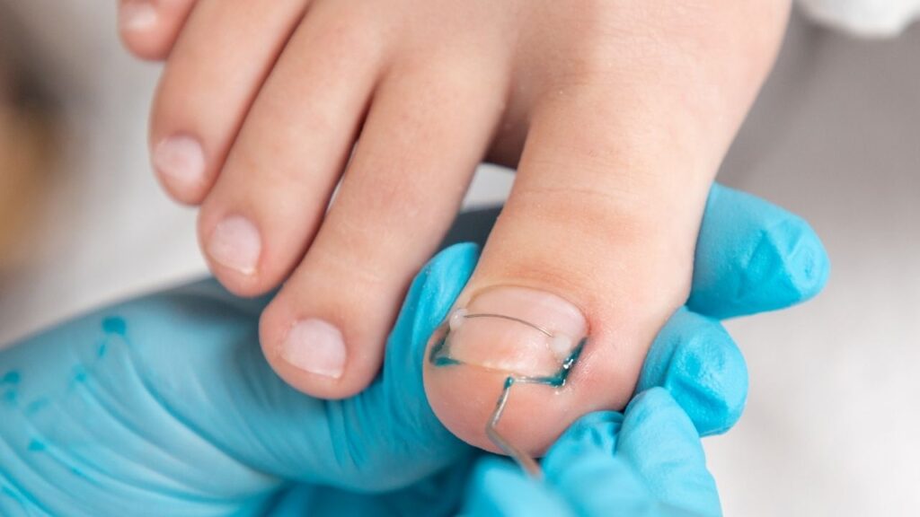 How to Prevent and Treat Ingrown Toenails: Risk Factors and Effective Solutions