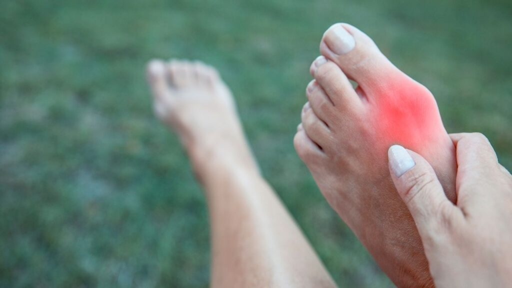 Bunions – Why Consult a Podiatrist?